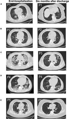 Alternation of the Autonomic Nervous System Is Associated With Pulmonary Sequelae in Patients With COVID-19 After Six Months of Discharge